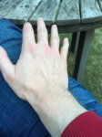 normal hand with itraconazole.jpg