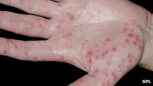 _67844343_c0147980-hand,_foot_and_mouth_disease-spl.jpg