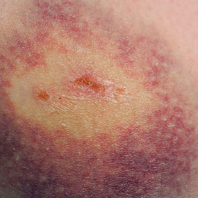 285x285_Pictures_Of_Leukemia_Rashes_And_Bruises_6.jpg