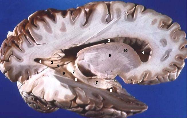Human_brain_right_dissected_lateral_view_description.JPG