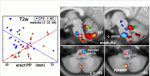 MRI CFS Brain stem.gif