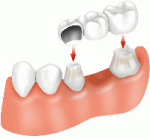 Dental_Bridge_Placement.gif