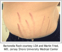 bartonella-rash.gif