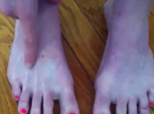 acrocyanosis-pictures-2.jpg