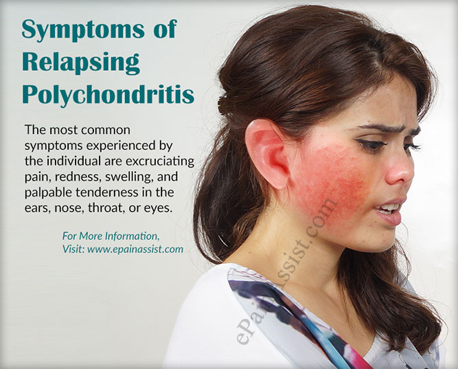 symptoms-of-relapsing-polychondritis.jpg