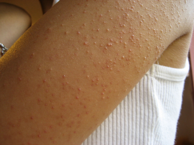 keratos-pilaris.jpg