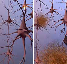 1922-amyloid..jpg
