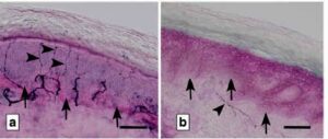 Small-fiber-neuropathy-300x127.jpg