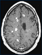 923-mri_brain.jpg