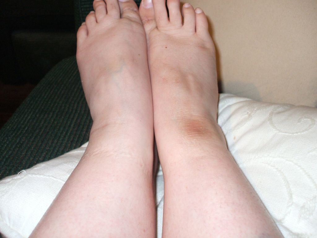 hyperpigmentationonmyleg-footcrease.jpg