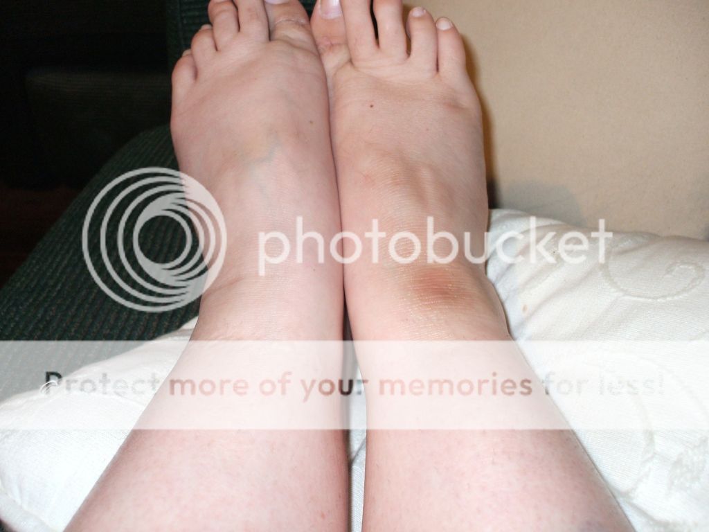 hyperpigmentationonmyleg-footcrease.jpg