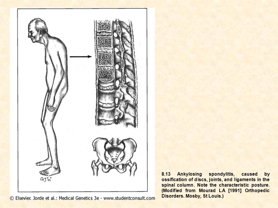 8.13+Ankylosing+spondylitis,+caused+by+ossification+of+discs,+joints,+and+ligaments+in+the+spinal+column..jpg