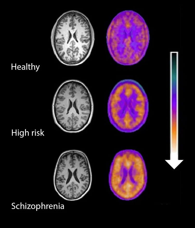 neuroinflammation-schizophrenia.jpg