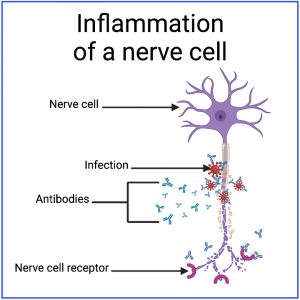 nerve-inflammation-300x300.jpg
